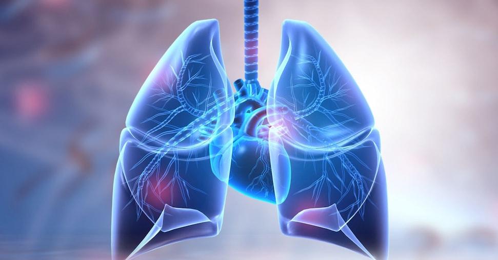 Pneumonia: Every year 150 thousand hospitalizations and 9 thousand deaths, here is an alarm to identify - IL only 24 points only 24 points